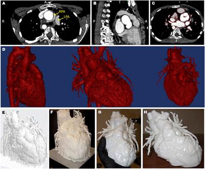 The Perception of a Three-Dimensional-Printed Heart Model from the Perspective of Different Stakeholders: A Complex Case of Truncus Arteriosus